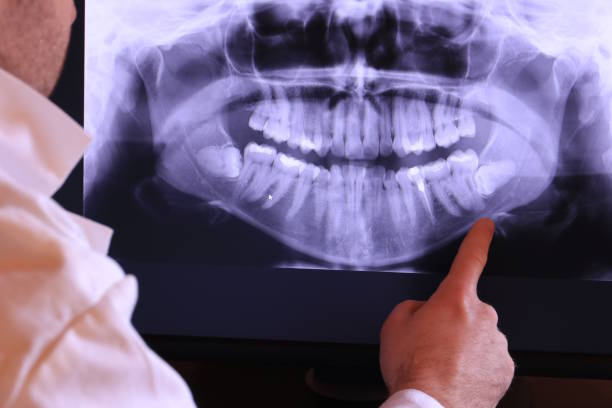 Best Emergency Wisdom Teeth Removal in Clark, SD